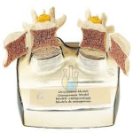Osteoporosis Model